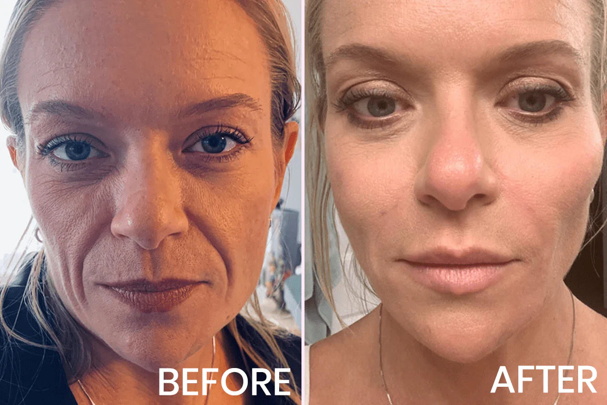 Marbella Invisible Face Lifting Tape