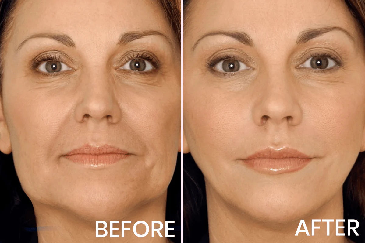 Marbella Invisible Face Lifting Tape
